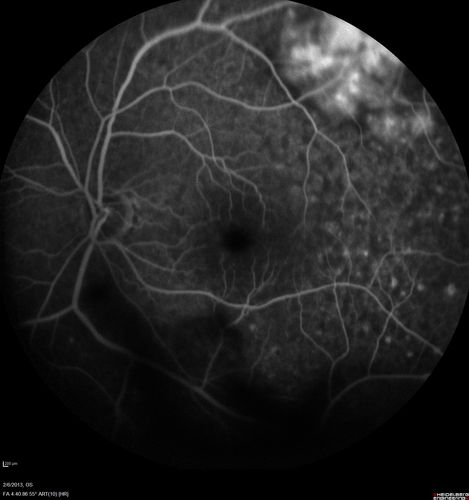 Vasculitis - Retinitis - Uveitis - Vision NLP right eye , 20/50 left eye
