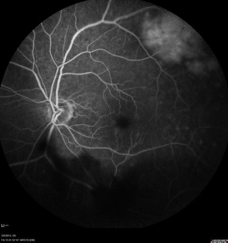Vasculitis - Retinitis - Uveitis - Vision NLP right eye , 20/50 left eye
