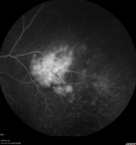 Vasculitis - Retinitis - Uveitis - Vision NLP right eye , 20/50 left eye
