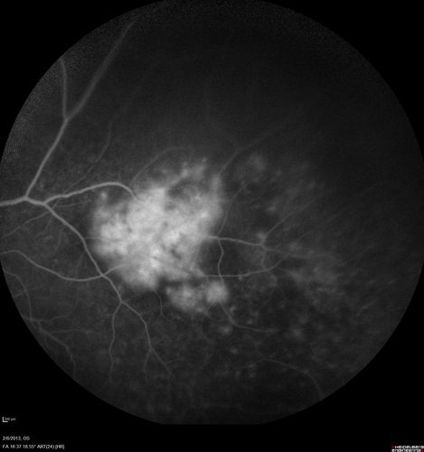 Vasculitis - Retinitis - Uveitis - Vision NLP right eye , 20/50 left eye
