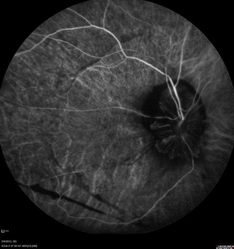 Vasculitis - Retinitis - Uveitis - Vision NLP right eye , 20/50 left eye
