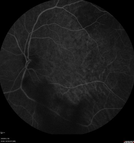 Vasculitis - Retinitis - Uveitis - Vision NLP right eye , 20/50 left eye
