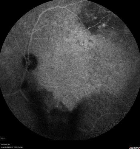 Vasculitis - Retinitis - Uveitis - Vision NLP right eye , 20/50 left eye
