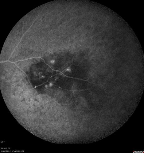 Vasculitis - Retinitis - Uveitis - Vision NLP right eye , 20/50 left eye
