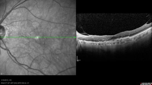 Wet AMD - New Small Hemorrhage Both Eyes - Mature CNVM visible on Early Indocyanine Green Angiogram
