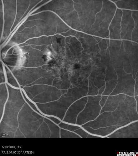 Wet AMD - New Small Hemorrhage Both Eyes - Mature CNVM visible on Early Indocyanine Green Angiogram
