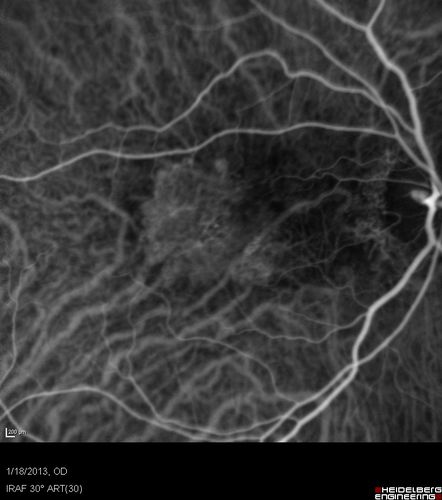 Wet AMD - New Small Hemorrhage Both Eyes - Mature CNVM visible on Early Indocyanine Green Angiogram
