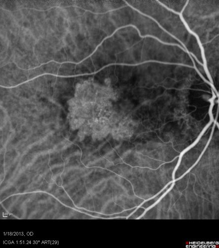 Wet AMD - New Small Hemorrhage Both Eyes - Mature CNVM visible on Early Indocyanine Green Angiogram
