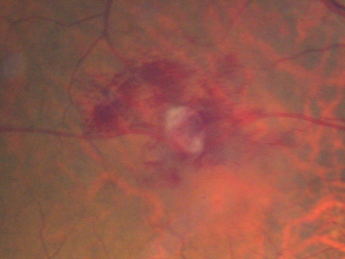 Retinal Arterial Macroaneurysm - Increased Swelling after Laser 
65-year-old woman was seen in the office on January 12, 2011.   She has noticed decreased vision in the right eye for the last two or three weeks.  She has had some discomfort in both eyes as well.  She has a history of low blood pressure, but she does have high cholesterol.  

VISUAL ACUITY:  OD 20/60
