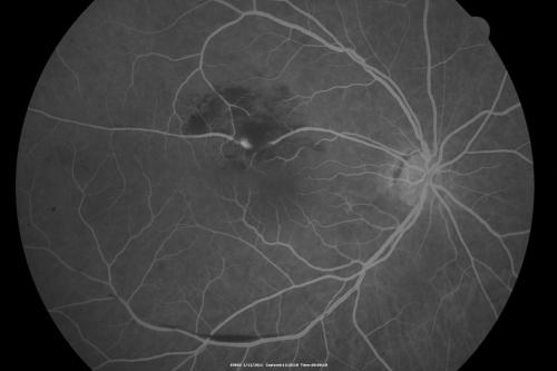 Retinal Arterial Macroaneurysm - Increased Swelling after Laser 
65-year-old woman was seen in the office on January 12, 2011.   She has noticed decreased vision in the right eye for the last two or three weeks.  She has had some discomfort in both eyes as well.  She has a history of low blood pressure, but she does have high cholesterol.  

VISUAL ACUITY:  OD 20/60
