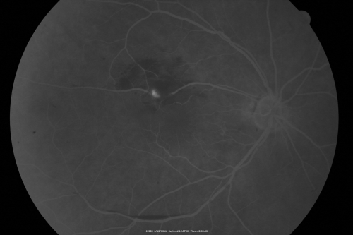 Retinal Arterial Macroaneurysm - Increased Swelling after Laser 
65-year-old woman was seen in the office on January 12, 2011.   She has noticed decreased vision in the right eye for the last two or three weeks.  She has had some discomfort in both eyes as well.  She has a history of low blood pressure, but she does have high cholesterol.  

VISUAL ACUITY:  OD 20/60
