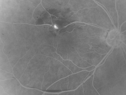 Retinal Arterial Macroaneurysm - Increased Swelling after Laser 
65-year-old woman was seen in the office on January 12, 2011.   She has noticed decreased vision in the right eye for the last two or three weeks.  She has had some discomfort in both eyes as well.  She has a history of low blood pressure, but she does have high cholesterol.  

VISUAL ACUITY:  OD 20/60
