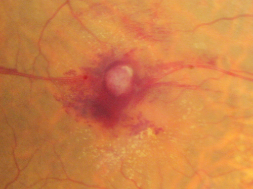 Retinal Arterial Macroaneurysm - Increased Swelling after Laser 
Visit 2 - 2 months later:
March 21, 2011.  This pleasant 66-year-old woman had laser to retinal arterial microaneurysm in the right eye January 12th.  Her vision was getting better, but now it is worse the last few days.  She is at home taking care of her demented mother and she and her sister lift her mother a fare amount of the time.  I also checked her blood pressure, which was 120/65.  VISUAL ACUITY:  OD 20/200


