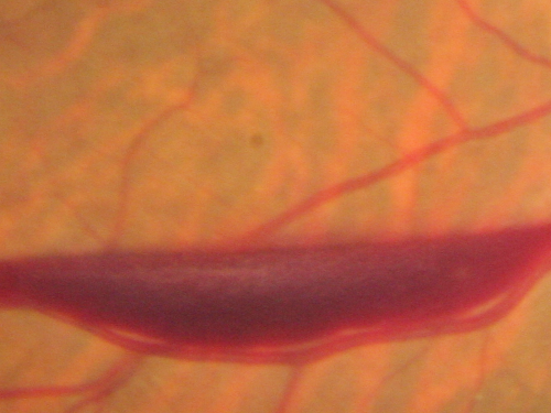 Retinal Arterial Macroaneurysm - Increased Swelling after Laser 
Visit 2 - 2 months later:
March 21, 2011.  This pleasant 66-year-old woman had laser to retinal arterial microaneurysm in the right eye January 12th.  Her vision was getting better, but now it is worse the last few days.  She is at home taking care of her demented mother and she and her sister lift her mother a fare amount of the time.  I also checked her blood pressure, which was 120/65.  VISUAL ACUITY:  OD 20/200


