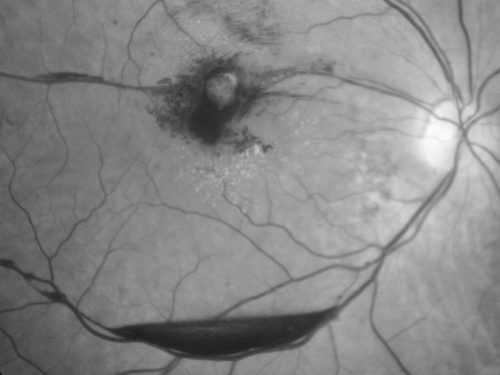 Retinal Arterial Macroaneurysm - Increased Swelling after Laser 
Visit 2 - 2 months later:
March 21, 2011.  This pleasant 66-year-old woman had laser to retinal arterial microaneurysm in the right eye January 12th.  Her vision was getting better, but now it is worse the last few days.  She is at home taking care of her demented mother and she and her sister lift her mother a fare amount of the time.  I also checked her blood pressure, which was 120/65.  VISUAL ACUITY:  OD 20/200


