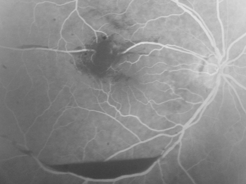 Retinal Arterial Macroaneurysm - Increased Swelling after Laser 
Visit 2 - 2 months later:
March 21, 2011.  This pleasant 66-year-old woman had laser to retinal arterial microaneurysm in the right eye January 12th.  Her vision was getting better, but now it is worse the last few days.  She is at home taking care of her demented mother and she and her sister lift her mother a fare amount of the time.  I also checked her blood pressure, which was 120/65.  VISUAL ACUITY:  OD 20/200


