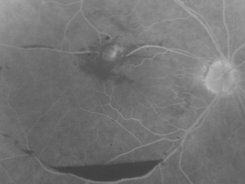 Retinal Arterial Macroaneurysm - Increased Swelling after Laser 
Visit 2 - 2 months later:
March 21, 2011.  This pleasant 66-year-old woman had laser to retinal arterial microaneurysm in the right eye January 12th.  Her vision was getting better, but now it is worse the last few days.  She is at home taking care of her demented mother and she and her sister lift her mother a fare amount of the time.  I also checked her blood pressure, which was 120/65.  VISUAL ACUITY:  OD 20/200


