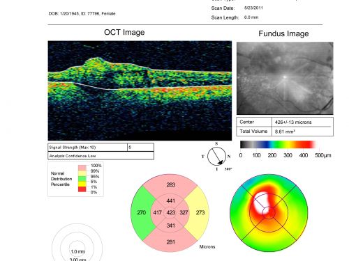 Retinal Arterial Macroaneurysm - Increased Swelling after Laser 
Visit 3 - 4 months post laser:
on May 23, 2011.  This pleasant 66-year-old woman had a leaky arterial macroaneurysm I lasered in January.  She developed more swelling subsequently, but an angiogram showed the lesion was closed.  Since then she has noticed her vision poor in the eye.  

VISUAL ACUITY:  OD 20/200


