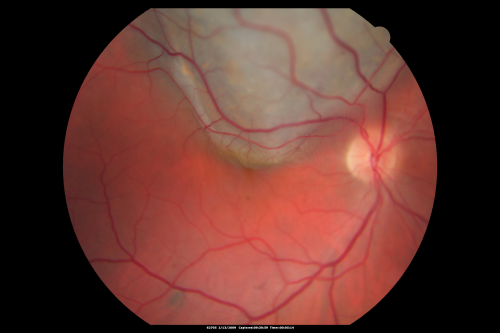 Choroidal Melanoma Medium
33-year-old man with a history of decreased in the right eye.  He had blurring in the eye about a year ago.  He reports that it improved spontaneously until it was â€œnearly resolvedâ€.  He said he had some persistent distortion, but that over the past couple of weeks he has noticed this dark spot recurring in the right eye, the left eye is unaffected.  He does not have any flashes, floaters or change in his peripheral visual acuity.   20/80 OD, 20/16 OS.  No improvement with pinhole.  IOP: 12 OD, 11 OS.  

POSTERIOR SEGMENT EXAMINATION: Shows a clear view with no PVD in either eye.  C/D ratio is 0.2 OU.  Large retinal vessels are unremarkable.  The macula of the right eye has a brown choroidal lesion with pigment overlying the surface and orange spots along its lateral surface.  The left macula is normal.  
B-SCAN:  B-scan ecography of the ultrasound of the right eye shows a mass about 5 mm high with a moderate to low internal reflectivity on A-scan echogram.  There is serous fluid inferiorly on the echogram
