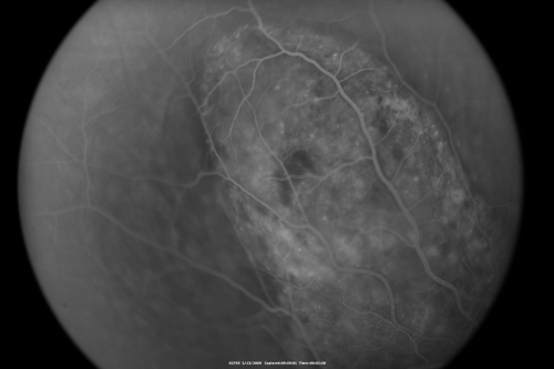 Choroidal Melanoma Medium
33-year-old man with a history of decreased in the right eye.  He had blurring in the eye about a year ago.  He reports that it improved spontaneously until it was â€œnearly resolvedâ€.  He said he had some persistent distortion, but that over the past couple of weeks he has noticed this dark spot recurring in the right eye, the left eye is unaffected.  He does not have any flashes, floaters or change in his peripheral visual acuity.   20/80 OD, 20/16 OS.  No improvement with pinhole.  IOP: 12 OD, 11 OS.  

POSTERIOR SEGMENT EXAMINATION: Shows a clear view with no PVD in either eye.  C/D ratio is 0.2 OU.  Large retinal vessels are unremarkable.  The macula of the right eye has a brown choroidal lesion with pigment overlying the surface and orange spots along its lateral surface.  The left macula is normal.  
B-SCAN:  B-scan ecography of the ultrasound of the right eye shows a mass about 5 mm high with a moderate to low internal reflectivity on A-scan echogram.  There is serous fluid inferiorly on the echogram

