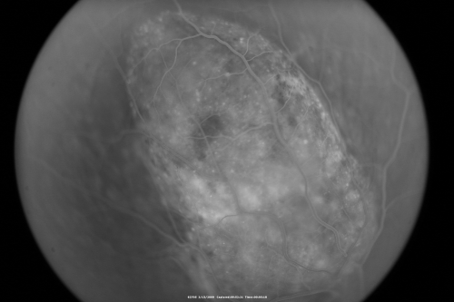 Choroidal Melanoma Medium
33-year-old man with a history of decreased in the right eye.  He had blurring in the eye about a year ago.  He reports that it improved spontaneously until it was â€œnearly resolvedâ€.  He said he had some persistent distortion, but that over the past couple of weeks he has noticed this dark spot recurring in the right eye, the left eye is unaffected.  He does not have any flashes, floaters or change in his peripheral visual acuity.   20/80 OD, 20/16 OS.  No improvement with pinhole.  IOP: 12 OD, 11 OS.  

POSTERIOR SEGMENT EXAMINATION: Shows a clear view with no PVD in either eye.  C/D ratio is 0.2 OU.  Large retinal vessels are unremarkable.  The macula of the right eye has a brown choroidal lesion with pigment overlying the surface and orange spots along its lateral surface.  The left macula is normal.  
B-SCAN:  B-scan ecography of the ultrasound of the right eye shows a mass about 5 mm high with a moderate to low internal reflectivity on A-scan echogram.  There is serous fluid inferiorly on the echogram
