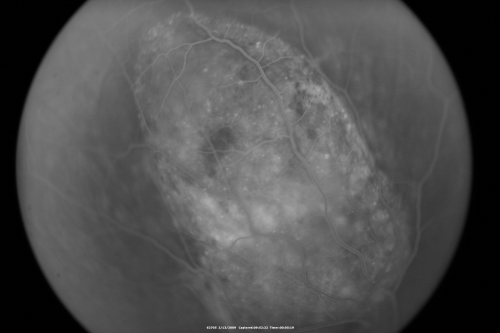 Choroidal Melanoma Medium
33-year-old man with a history of decreased in the right eye.  He had blurring in the eye about a year ago.  He reports that it improved spontaneously until it was â€œnearly resolvedâ€.  He said he had some persistent distortion, but that over the past couple of weeks he has noticed this dark spot recurring in the right eye, the left eye is unaffected.  He does not have any flashes, floaters or change in his peripheral visual acuity.   20/80 OD, 20/16 OS.  No improvement with pinhole.  IOP: 12 OD, 11 OS.  

POSTERIOR SEGMENT EXAMINATION: Shows a clear view with no PVD in either eye.  C/D ratio is 0.2 OU.  Large retinal vessels are unremarkable.  The macula of the right eye has a brown choroidal lesion with pigment overlying the surface and orange spots along its lateral surface.  The left macula is normal.  
B-SCAN:  B-scan ecography of the ultrasound of the right eye shows a mass about 5 mm high with a moderate to low internal reflectivity on A-scan echogram.  There is serous fluid inferiorly on the echogram
