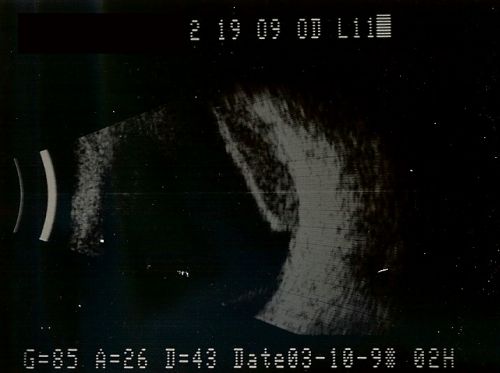 Choroidal Melanoma Medium
33-year-old man with a history of decreased in the right eye.  He had blurring in the eye about a year ago.  He reports that it improved spontaneously until it was â€œnearly resolvedâ€.  He said he had some persistent distortion, but that over the past couple of weeks he has noticed this dark spot recurring in the right eye, the left eye is unaffected.  He does not have any flashes, floaters or change in his peripheral visual acuity.   20/80 OD, 20/16 OS.  No improvement with pinhole.  IOP: 12 OD, 11 OS.  

POSTERIOR SEGMENT EXAMINATION: Shows a clear view with no PVD in either eye.  C/D ratio is 0.2 OU.  Large retinal vessels are unremarkable.  The macula of the right eye has a brown choroidal lesion with pigment overlying the surface and orange spots along its lateral surface.  The left macula is normal.  
B-SCAN:  B-scan ecography of the ultrasound of the right eye shows a mass about 5 mm high with a moderate to low internal reflectivity on A-scan echogram.  There is serous fluid inferiorly on the echogram
