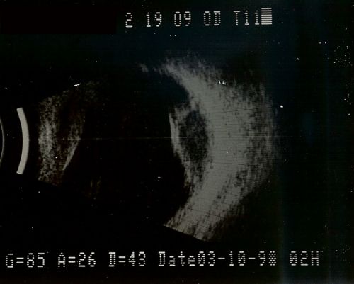 Choroidal Melanoma Medium
33-year-old man with a history of decreased in the right eye.  He had blurring in the eye about a year ago.  He reports that it improved spontaneously until it was â€œnearly resolvedâ€.  He said he had some persistent distortion, but that over the past couple of weeks he has noticed this dark spot recurring in the right eye, the left eye is unaffected.  He does not have any flashes, floaters or change in his peripheral visual acuity.   20/80 OD, 20/16 OS.  No improvement with pinhole.  IOP: 12 OD, 11 OS.  

POSTERIOR SEGMENT EXAMINATION: Shows a clear view with no PVD in either eye.  C/D ratio is 0.2 OU.  Large retinal vessels are unremarkable.  The macula of the right eye has a brown choroidal lesion with pigment overlying the surface and orange spots along its lateral surface.  The left macula is normal.  
B-SCAN:  B-scan ecography of the ultrasound of the right eye shows a mass about 5 mm high with a moderate to low internal reflectivity on A-scan echogram.  There is serous fluid inferiorly on the echogram
