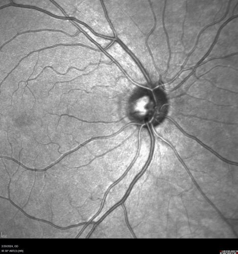 Advanced age-related macular degeneration
87 year old female.  Severe macular bleed 15 years ago OD.  Now with disciform scar.  Left eye has progressing geographic atrophy.
VA OD: HM,  OS: 5/200.  IOP normal OU
