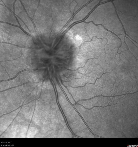 Advanced age-related macular degeneration
87 year old female.  Severe macular bleed 15 years ago OD.  Now with disciform scar.  Left eye has progressing geographic atrophy.
VA OD: HM,  OS: 5/200.  IOP normal OU
