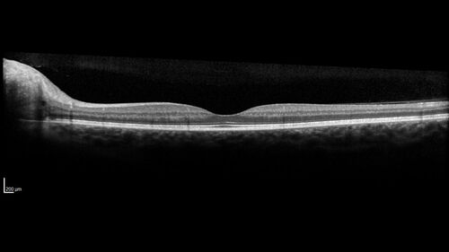 Advanced age-related macular degeneration
87 year old female.  Severe macular bleed 15 years ago OD.  Now with disciform scar.  Left eye has progressing geographic atrophy.
VA OD: HM,  OS: 5/200.  IOP normal OU
