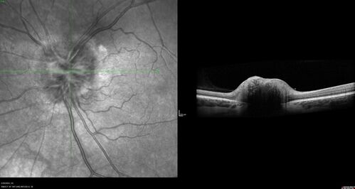 Advanced age-related macular degeneration
87 year old female.  Severe macular bleed 15 years ago OD.  Now with disciform scar.  Left eye has progressing geographic atrophy.
VA OD: HM,  OS: 5/200.  IOP normal OU

