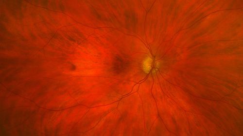 Atypical High Risk Choroidal Nevus vs Macular Melanoma
70 year old female with vision loss in the left eye for a few weeks.  She was referred to a tumor center and being managed as an 