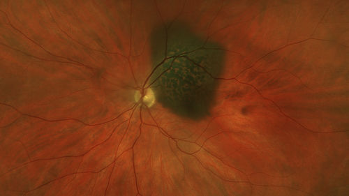 Atypical High Risk Choroidal Nevus vs Macular Melanoma
70 year old female with vision loss in the left eye for a few weeks.  She was referred to a tumor center and being managed as an 