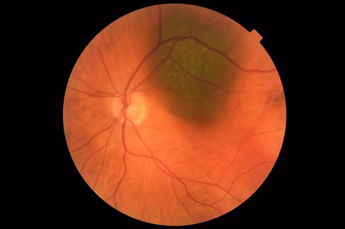 Atypical High Risk Choroidal Nevus vs Macular Melanoma
70 year old female with vision loss in the left eye for a few weeks.  She was referred to a tumor center and being managed as an 