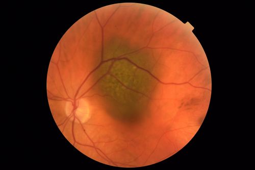Atypical High Risk Choroidal Nevus vs Macular Melanoma
70 year old female with vision loss in the left eye for a few weeks.  She was referred to a tumor center and being managed as an 