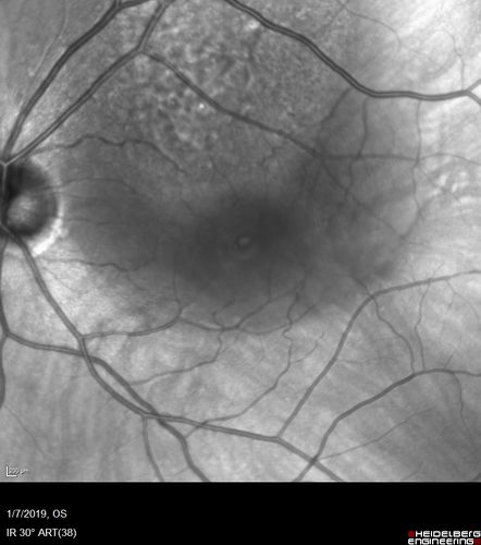 Atypical High Risk Choroidal Nevus vs Macular Melanoma
70 year old female with vision loss in the left eye for a few weeks.  She was referred to a tumor center and being managed as an 