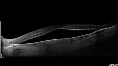 Atypical High Risk Choroidal Nevus vs Macular Melanoma
70 year old female with vision loss in the left eye for a few weeks.  She was referred to a tumor center and being managed as an 