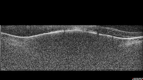 Atypical High Risk Choroidal Nevus vs Macular Melanoma
70 year old female with vision loss in the left eye for a few weeks.  She was referred to a tumor center and being managed as an 