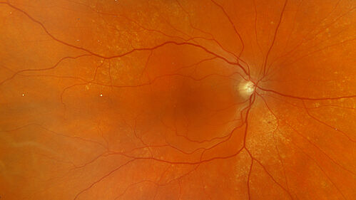 Serous Macular Detachment from Small Choroidal Melanoma
72 year old female misdiagnosed as CSR who had small choroidal melanoms.
