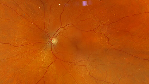 Serous Macular Detachment from Small Choroidal Melanoma
72 year old female misdiagnosed as CSR who had small choroidal melanoms.
