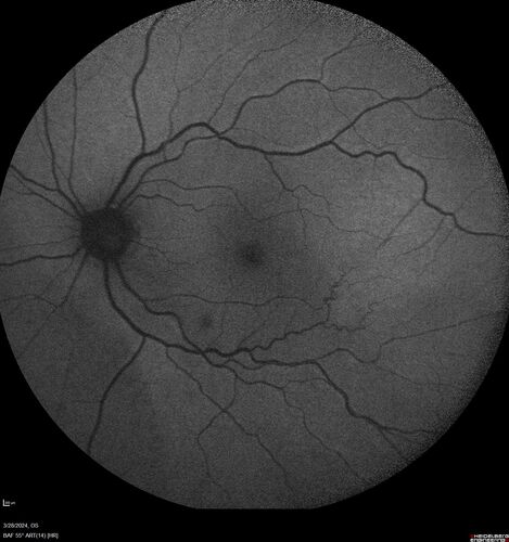 Serous Macular Detachment from Small Choroidal Melanoma
72 year old female misdiagnosed as CSR who had small choroidal melanoms.
