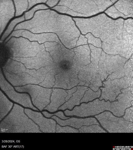 Serous Macular Detachment from Small Choroidal Melanoma
72 year old female misdiagnosed as CSR who had small choroidal melanoms.
