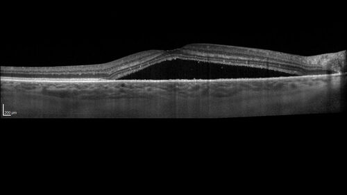 Serous Macular Detachment from Small Choroidal Melanoma
72 year old female misdiagnosed as CSR who had small choroidal melanoms.
