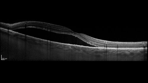 Serous Macular Detachment from Small Choroidal Melanoma
72 year old female misdiagnosed as CSR who had small choroidal melanoms.
