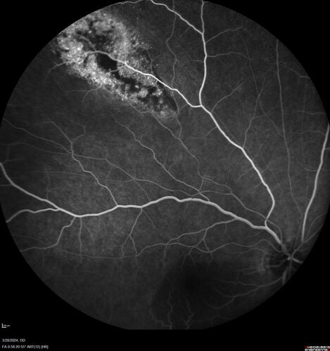 Serous Macular Detachment from Small Choroidal Melanoma
72 year old female misdiagnosed as CSR who had small choroidal melanoms.
