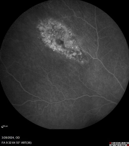 Serous Macular Detachment from Small Choroidal Melanoma
72 year old female misdiagnosed as CSR who had small choroidal melanoms.
