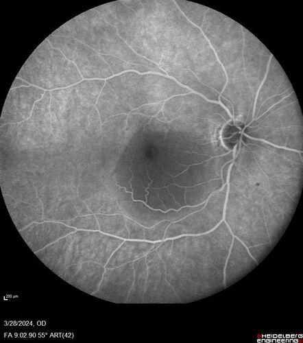 Serous Macular Detachment from Small Choroidal Melanoma
72 year old female misdiagnosed as CSR who had small choroidal melanoms.
