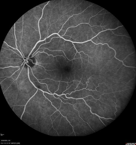 Serous Macular Detachment from Small Choroidal Melanoma
72 year old female misdiagnosed as CSR who had small choroidal melanoms.
