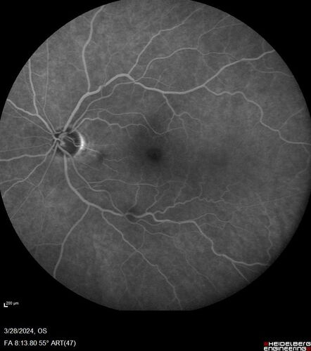 Serous Macular Detachment from Small Choroidal Melanoma
72 year old female misdiagnosed as CSR who had small choroidal melanoms.
